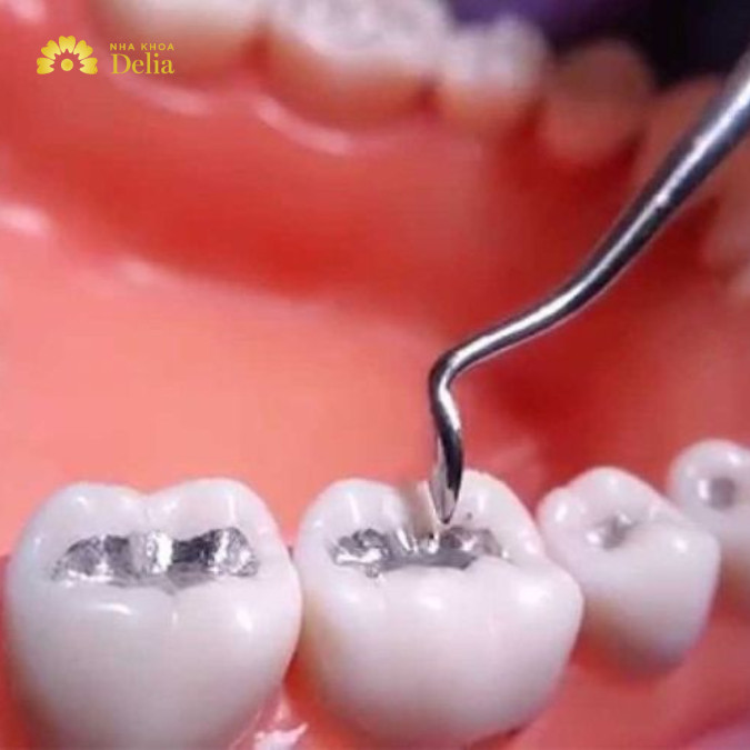 Trám răng có bền không phụ thuộc phần lớn vào loại vật liệu được sử dụng