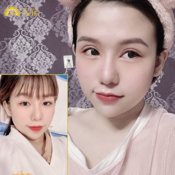 Cắt mí tạo mắt bồ câu