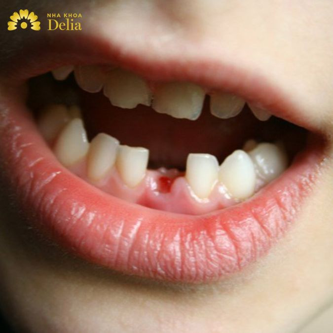 Theo nhiều chuyên gia chia sẻ việc nằm mơ thấy răng rụng là do liên quan đến độ căng của răng