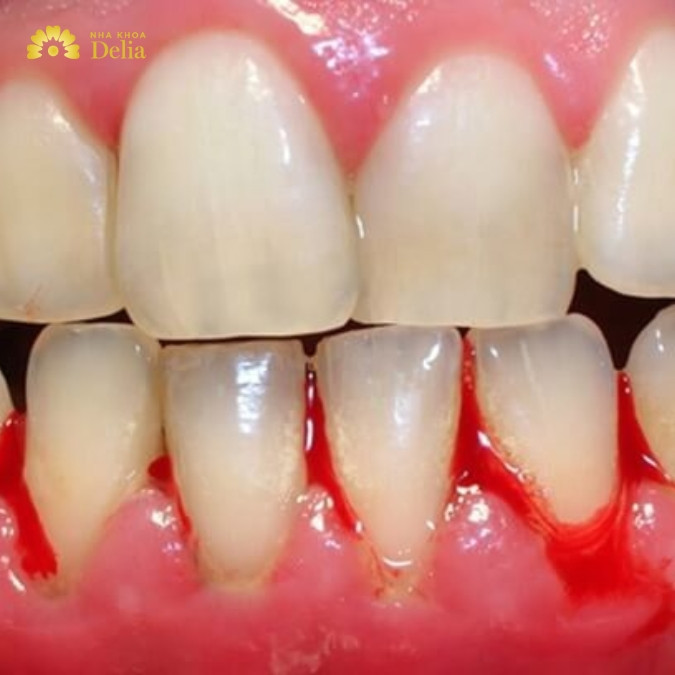 Nhổ răng và những biến chứng có thể gặp phải