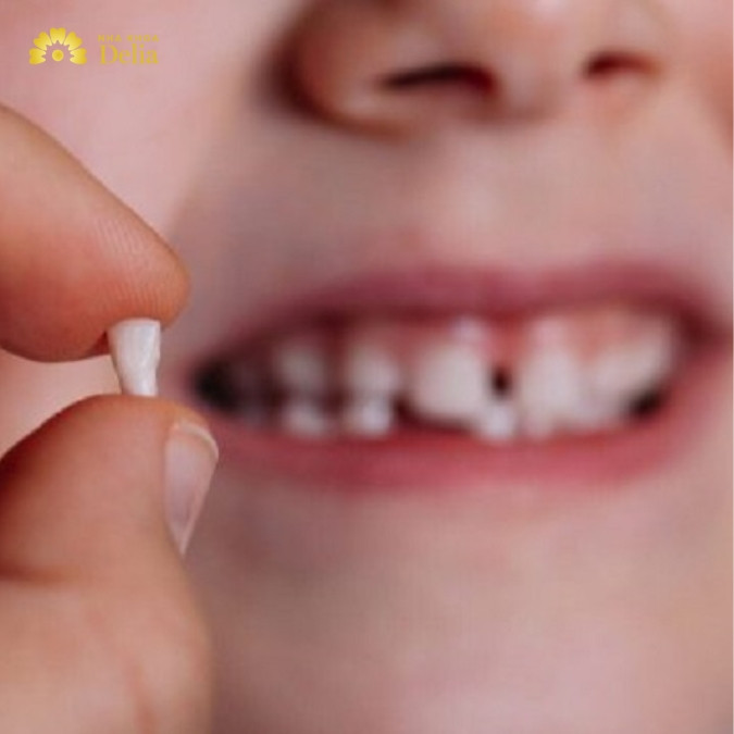 Nhổ răng là gì? Không nhổ răng có sao không?
