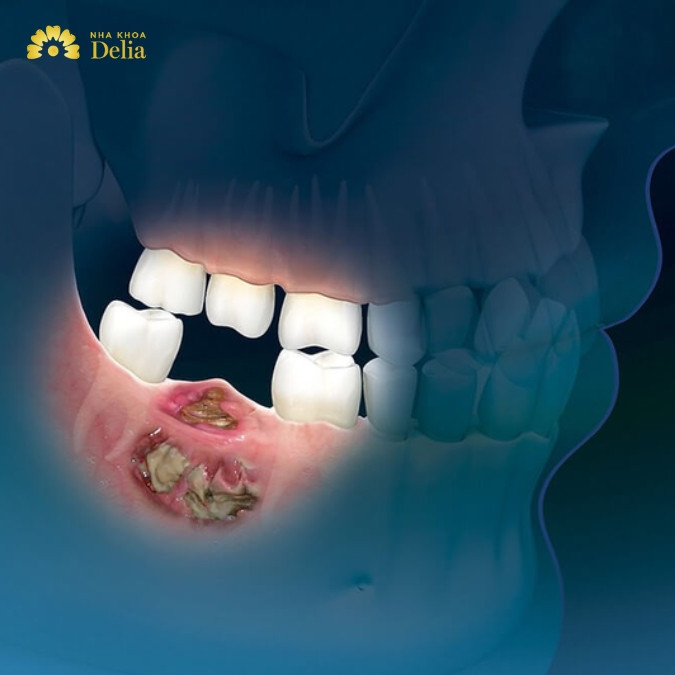 Nhổ răng bị lộ xương hàm trong trường hợp nào? 