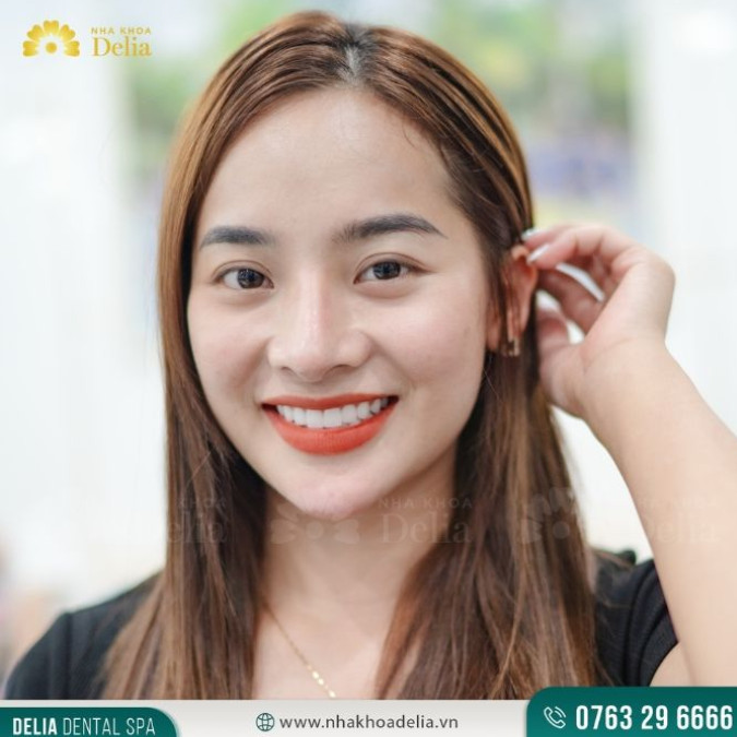Răng bị vỡ không thể hàn cần làm gì - Bọc răng sứ