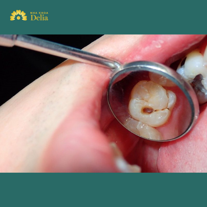 Tác hại của việc trám răng: tăng nguy cơ sâu răng