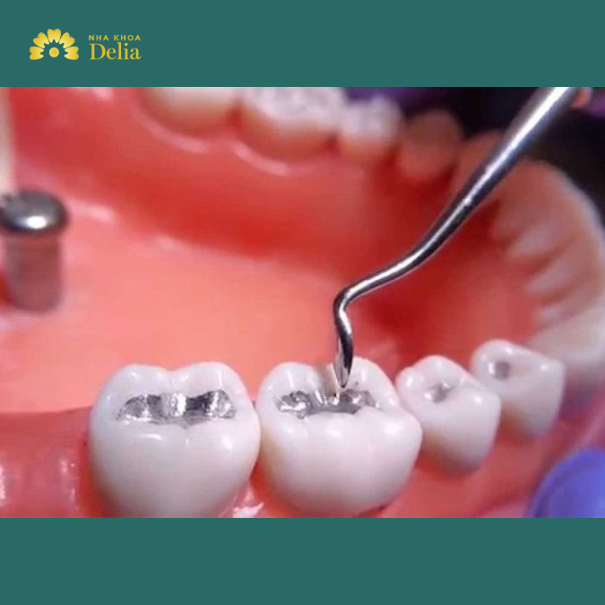 Vật liệu trám không chất lượng dễ ảnh hưởng đến sức khỏe