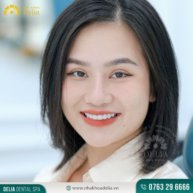 So với tẩy trắng răng bằng máng thì bọc sứ có hiệu quả hơn hẳn