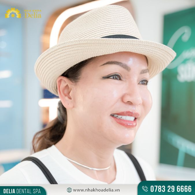 Dán răng sứ (dán răng sứ Veneer) là phương pháp sử dụng mặt dán sứ mỏng khoảng từ 0.2 mm – 0.5 mm