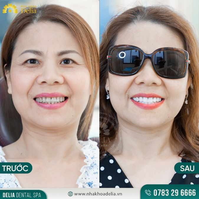 Những trường hợp chăm sóc sức khỏe răng miệng tốt có thể giữ được lâu hơn đến tận 4 - 5 năm