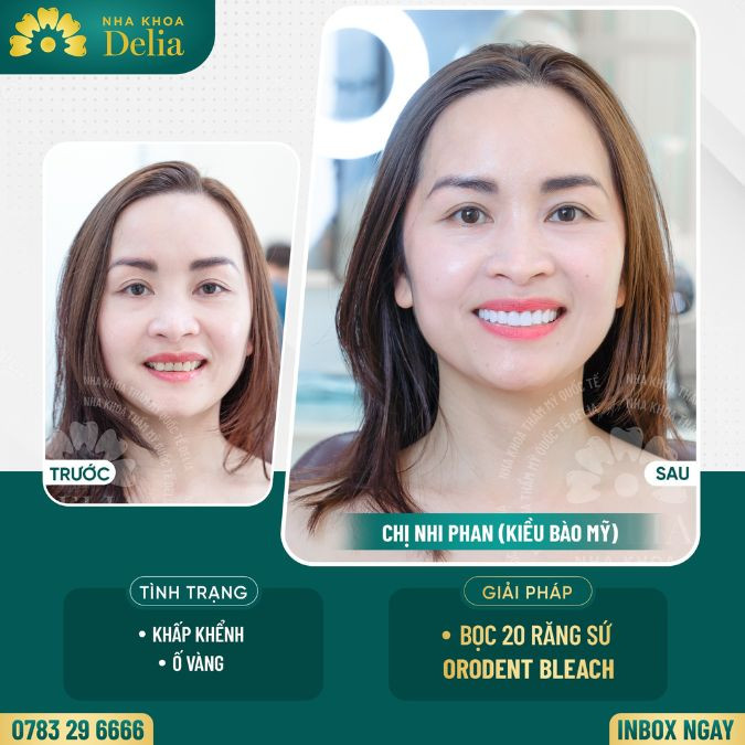 Bọc răng sứ