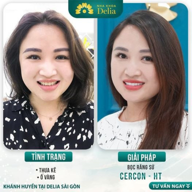 Trám kẽ hở giữa 2 răng bao nhiêu tiền, làm ở đâu uy tín, chất lượng?
