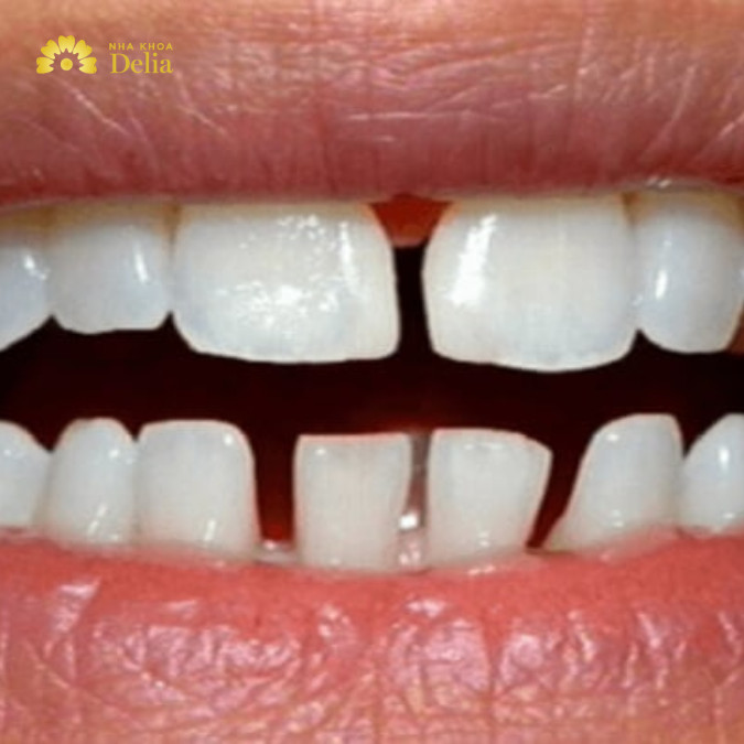 Nguyên nhân răng thưa, hở kẽ: do di truyền