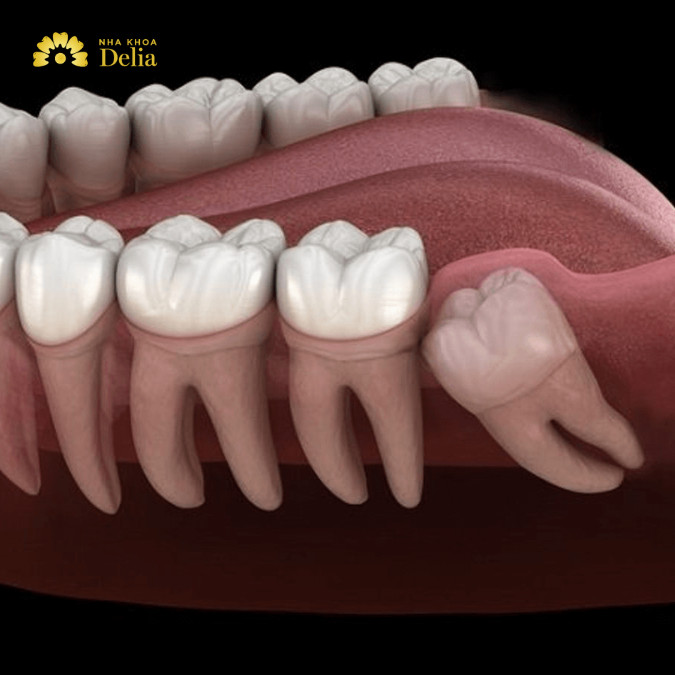 Răng số 8 bị sâu có hàn được không?