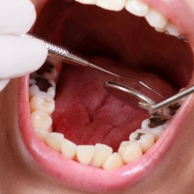 Trám răng mất bao lâu?