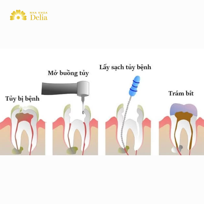 Trám răng lấy tủy mất bao lâu?