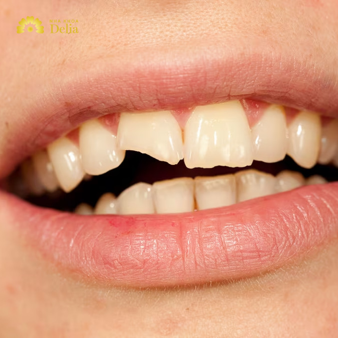 Trám răng sứt mẻ mất bao lâu?