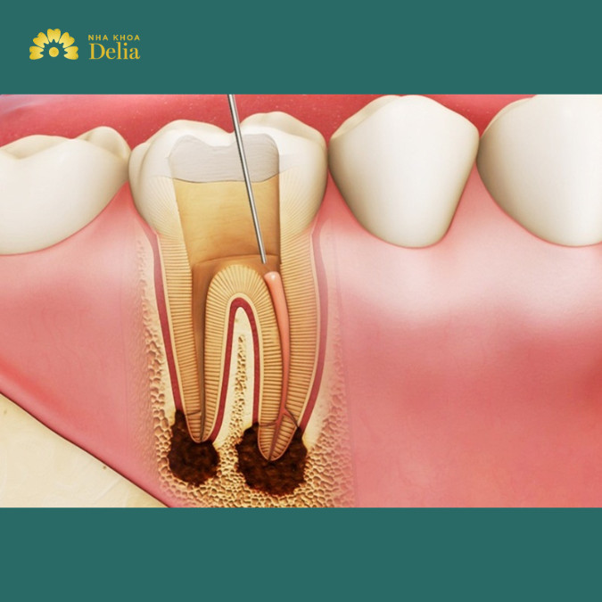Chưa lấy hết tủy răng khiến răng bị sâu lại