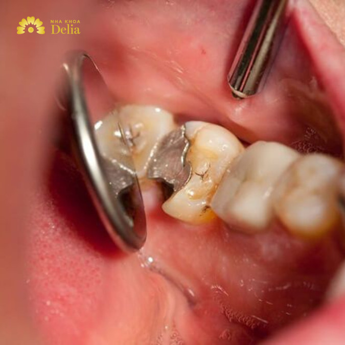 Trám răng số 6 bao nhiêu tiền?