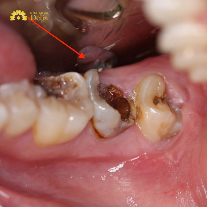 Trám răng xong bị nhức nguyên nhân do đâu: do sâu răng chưa được loại bỏ hoàn toàn