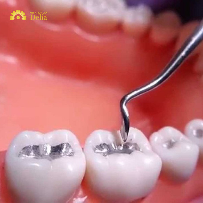 Trám răng xong có ăn được không, bao lâu thì ăn uống bình thường?