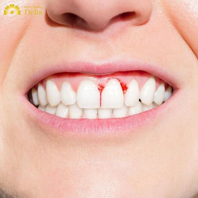 màu sắc của lợi sẽ thay đổi, chuyển sang nâu sẫm hoặc đỏ thẫm