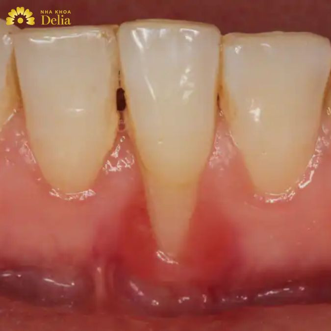 Hạn chế ăn đồ lạnh hoặc nóng bởi nhiệt độ thấp hoặc quá cao dễ dẫn tới tình trạng men răng thị tổn thương
