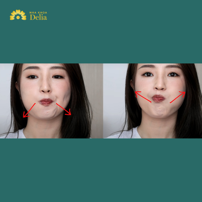 Bài tập cải thiện mặt lệch chu môi, phồng má