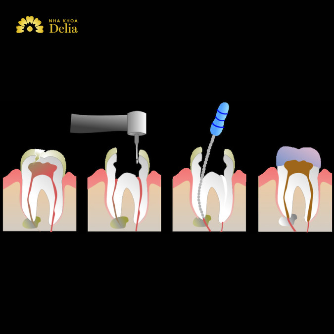 Lấy tủy răng có ảnh hưởng gì không?