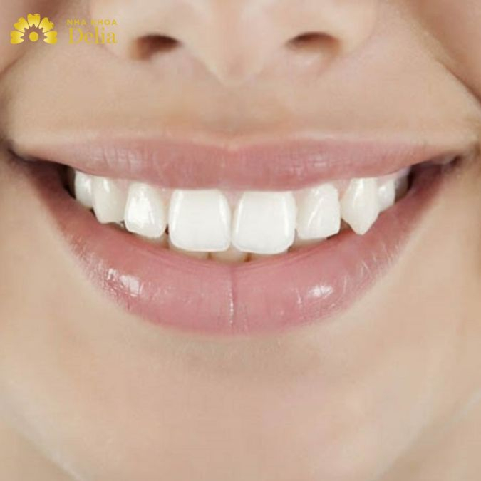 Răng khểnh hay răng nanh mọc lệch sẽ không mọc thẳng như những răng khác