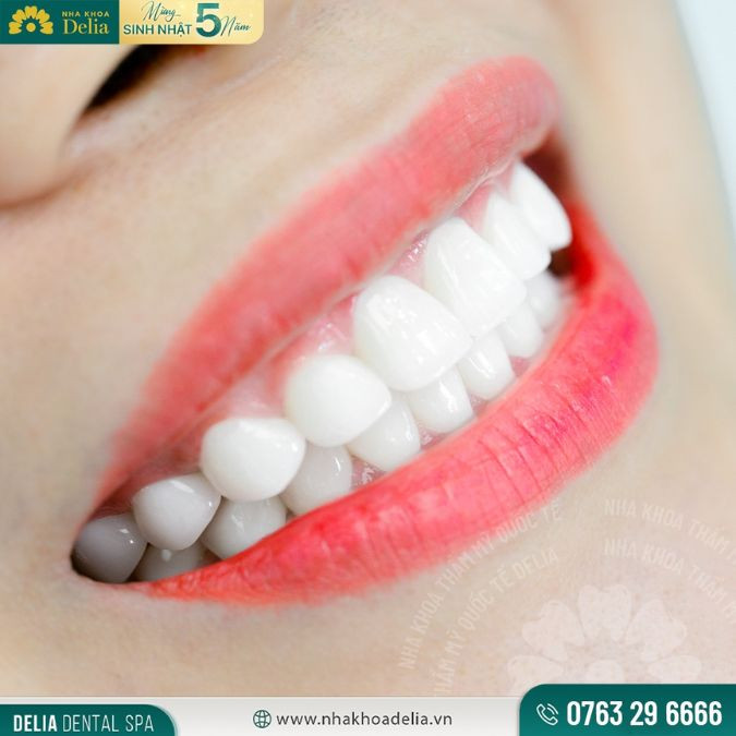 Dáng răng sứ tự nhiên giúp cho người sở hữu thăng hạng nhan sắc