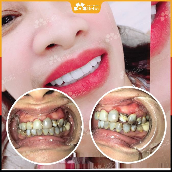 Giải pháp cải thiện tình trạng răng sứ hỏng và khiến bạn lấy lại sự tự tin hơn đơn giản chính là đến nha khoa uy tín bọc răng sứ