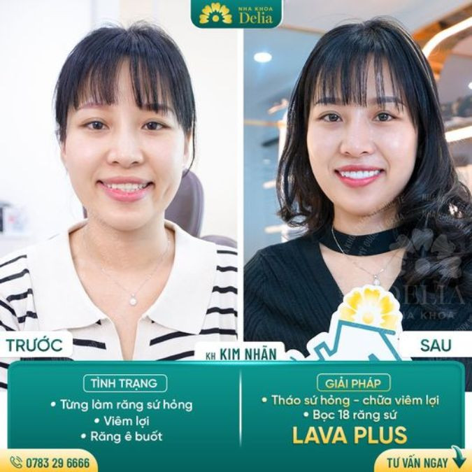 Chị Kim Nhãn - Bọc 18 răng sứ Lava Plus