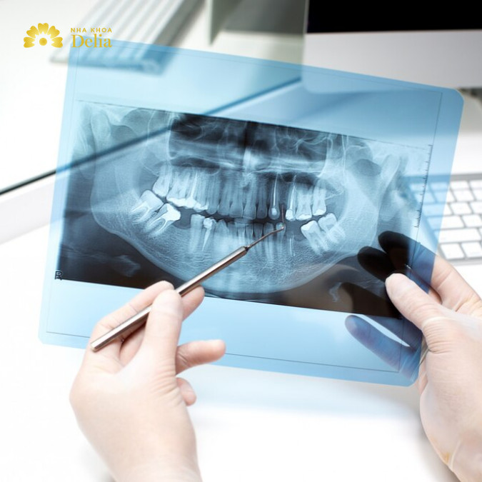Hối hận khi trồng Implant quá trễ: tiêu xương hàm
