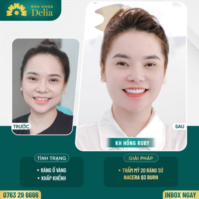 Khách hàng Hồng Ruby - Thẩm mỹ 20 răng sứ Nacera Q3 Burn