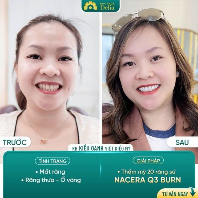 Khách hàng Kiều Oanh - Thẩm mỹ 20 răng sứ Nacera Q3 Burn