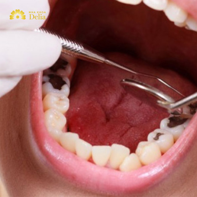 Răng như thế nào mới cần lấy tủy