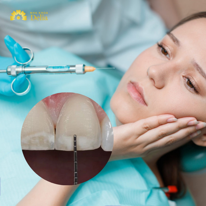Giải đáp: Mài răng có tiêm thuốc tê không?