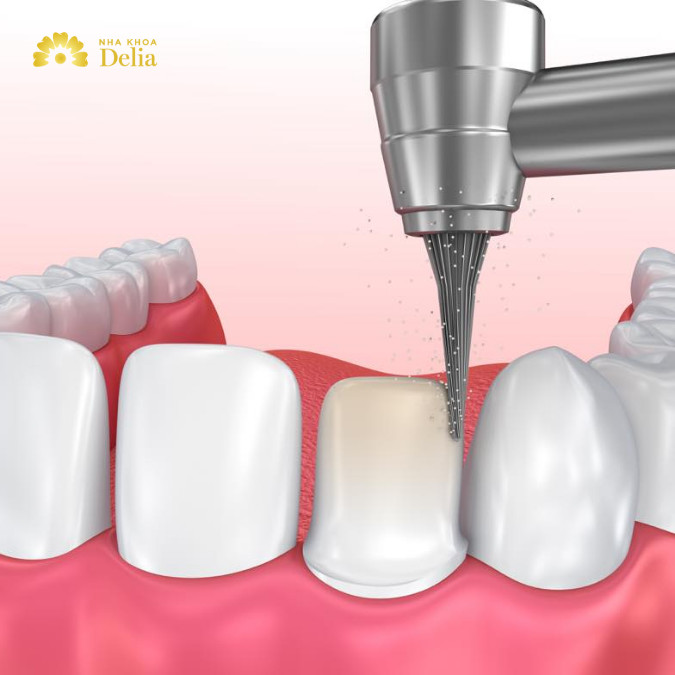 Mài răng có tiêm thuốc tê không?