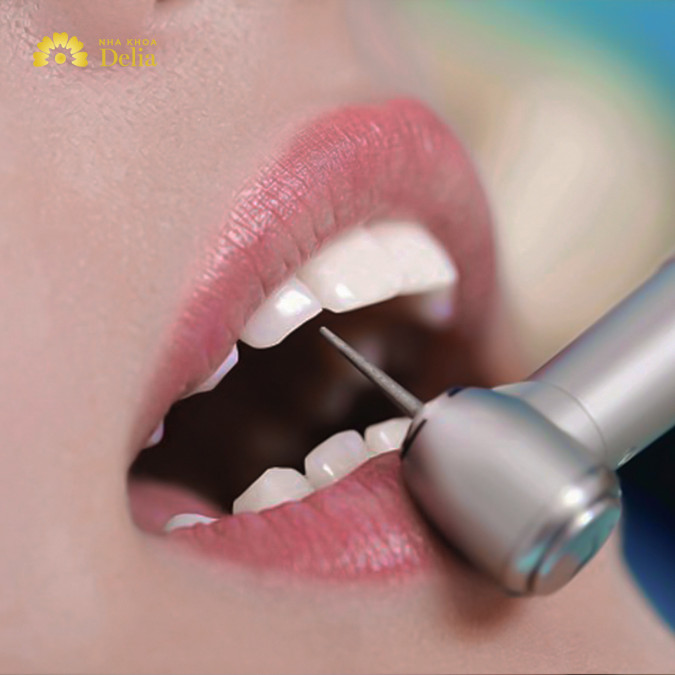 Mài răng có ảnh hưởng gì không