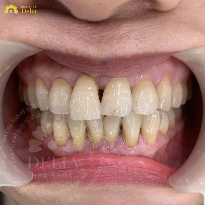 Khớp cắn bị lệch gây ra tình trạng răng bị mòn