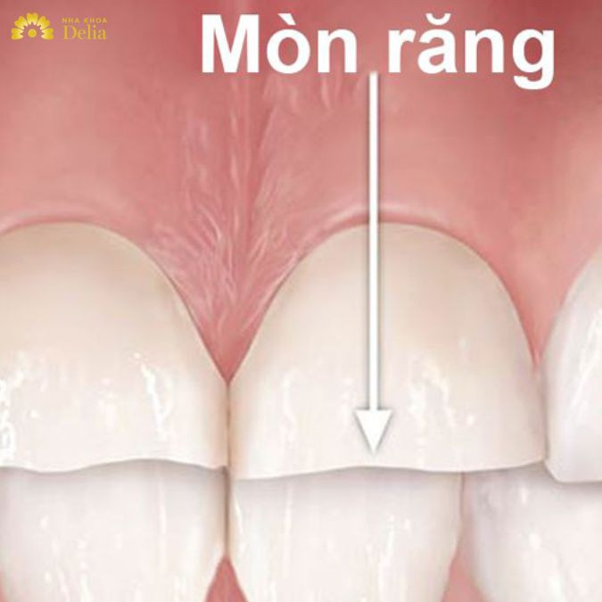 Nghiến răng khi ngủ gây ra tình trạng răng bị mòn