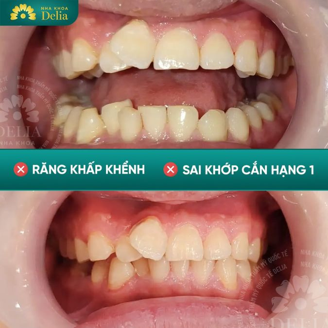 theo tướng số dáng răng 9630 rất xấu