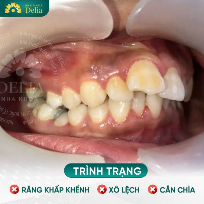 Răng 9630 là dáng răng khấp khểnh, mọc không thẳng hàng thẳng lối, lộn xộn