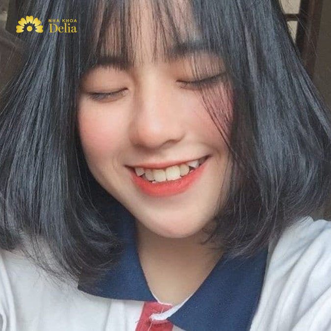 Răng khểnh là gì, có đặc điểm gì nổi bật?