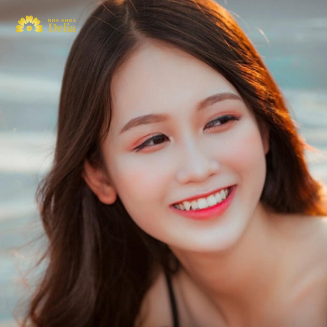 Có nên niềng răng khểnh không?
