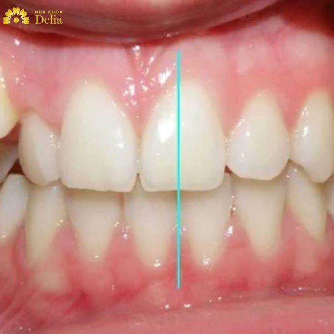 kẽ hai răng cửa bị lệch sang phải hoặc lệch sang trái so với đường nhân trung
