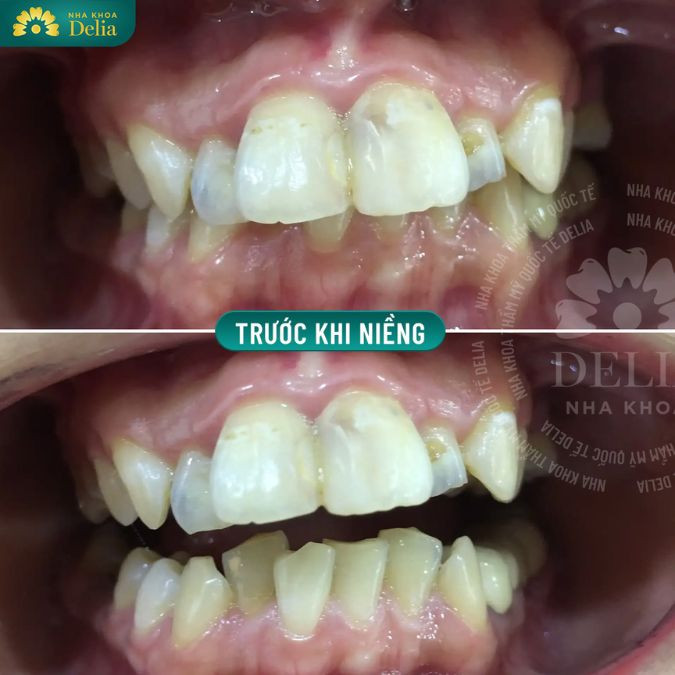 Răng mọc chồng lên nhau, hoặc mọc ra ngoài, vào trong