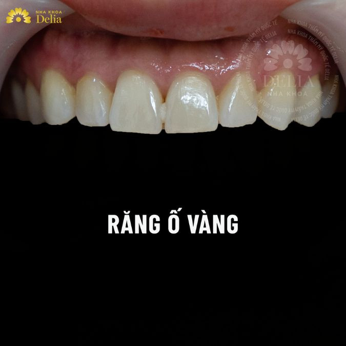 Nhựa thuốc lá và lớp màng mỏng trên răng dễ khiến răng ố vàng, xỉn màu
