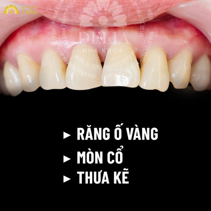 Sử dụng Baking soda cải thiện tình trạng ố vàng răng