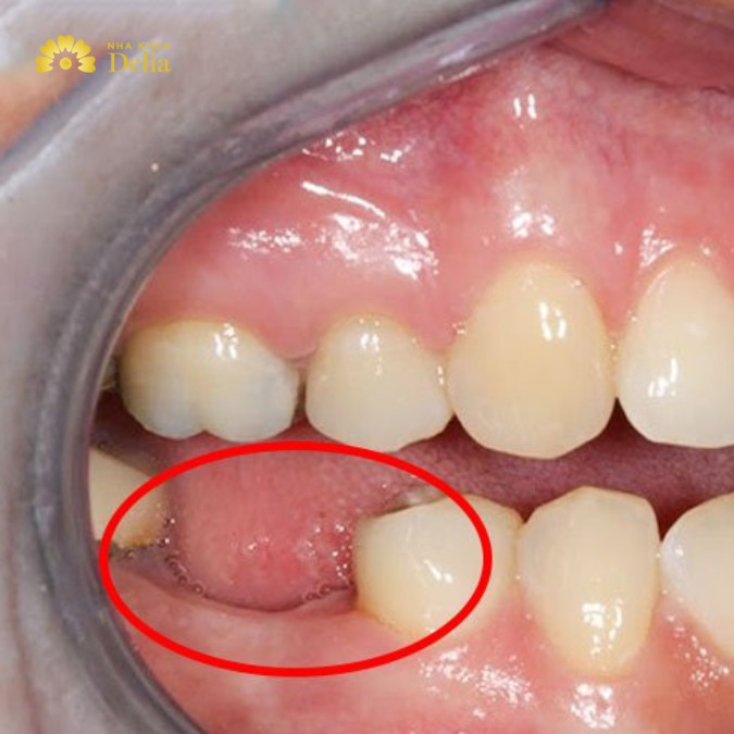 Răng sâu quá nặng có thể dẫn tới mất răng vĩnh viễn