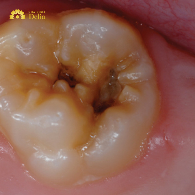 Răng sâu đen có tự khỏi được không?